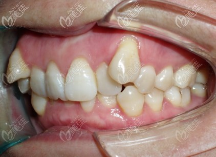 深覆合加牙齒擁擠的側(cè)面照 深覆合加牙齒擁擠的側(cè)面照