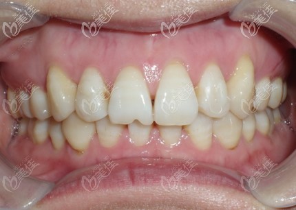 矯正后的牙齒 矯正后的牙齒