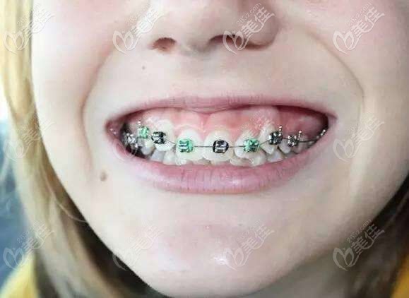 牙列擁擠+深覆合矯正效果你值得一看,花費(fèi)兩年時(shí)間也值得！