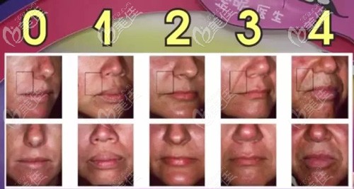 不同程度的法令紋