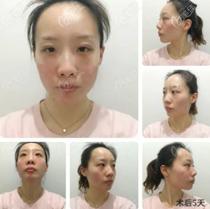 第五天臉還有點兒紅 第五天臉還有點兒紅