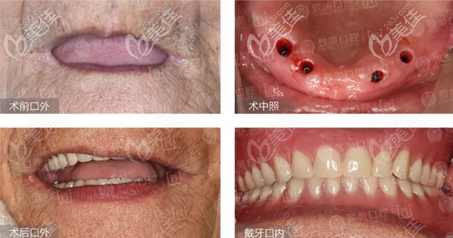 驚訝!隔壁張奶奶花了15萬做allon4全口德國種植牙,當(dāng)場都能吃蘋果了