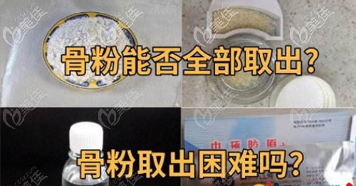 骨膜貼片和骨粉成分相同都很難取出