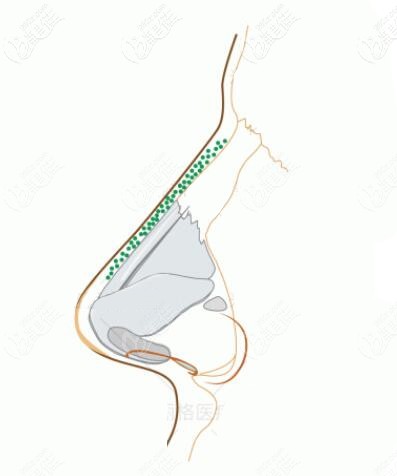 骨膜貼片和骨粉成分相似