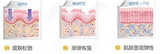 射頻治療皮膚過程 射頻治療皮膚過程