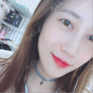 深圳美萊去眼袋很靠譜,因為我找美萊林登文做過眶隔脂肪釋放祛眼袋效果不錯