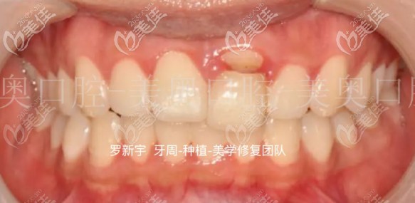 門牙斷裂未治療的圖片 門牙斷裂未治療的圖片