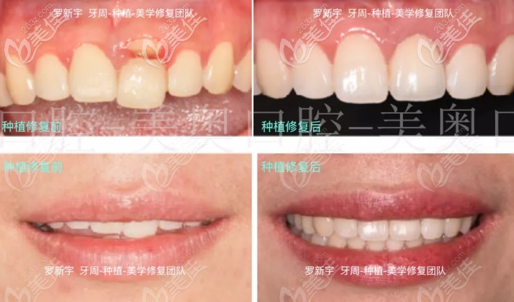 這是我在常州美奧口腔剛做完前門牙即刻種植的效果