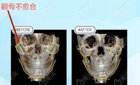 顴骨磨骨失敗修復(fù)手術(shù)效果