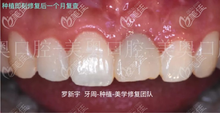 即刻種植一個月后的復查圖片 即刻種植一個月后的復查圖片