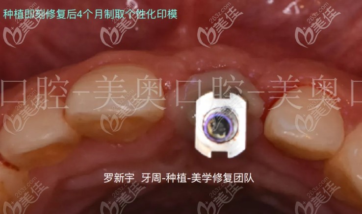 即刻種植4個月后的個性化印模 即刻種植4個月后的個性化印模