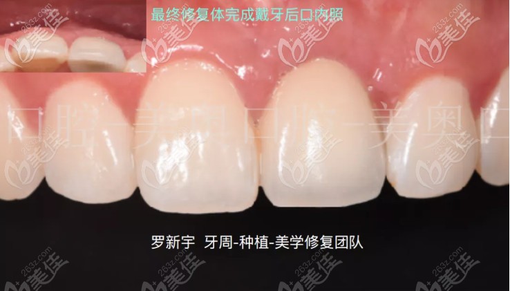 即刻種植牙已經(jīng)完成 即刻種植牙已經(jīng)完成