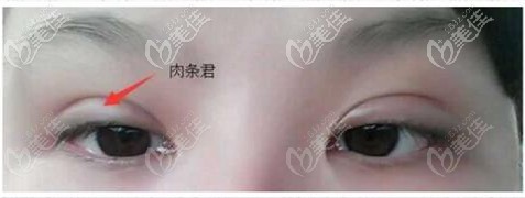 眼部有肉條感