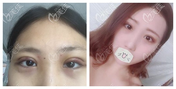 雅芳亞整形做雙眼皮修復(fù)案例