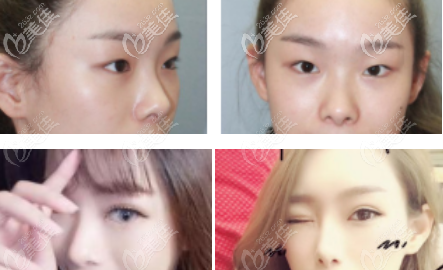 深圳希思雙眼皮案例