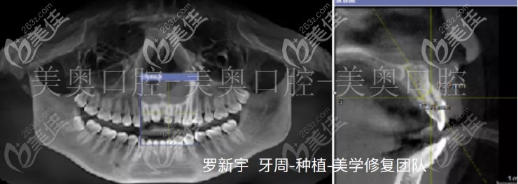 我的術前片子 我的術前片子