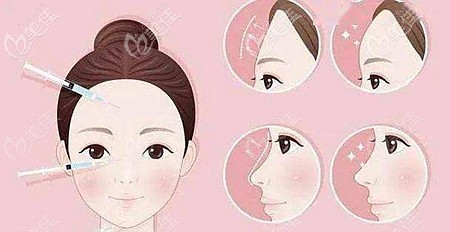 湯芳芳醫(yī)生在玻尿酸填充方面的優(yōu)勢(shì)