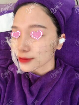 衡陽雅美真人體驗面部熱瑪吉過程中