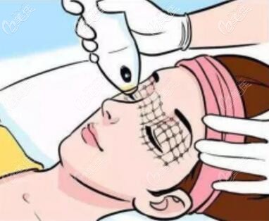 衡陽雅美五代熱極塑FLX（熱瑪吉）優(yōu)惠活動進行中