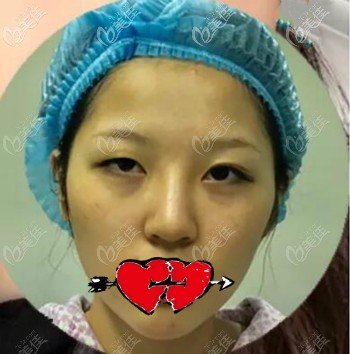 找武漢涵美馮曉玲割雙眼皮術(shù)前照片 找武漢涵美馮曉玲割雙眼皮術(shù)前照片