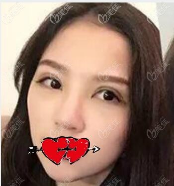 武漢涵美馮曉玲割雙眼皮術(shù)后第7天效果 武漢涵美馮曉玲割雙眼皮術(shù)后第7天效果