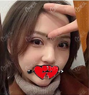 武漢涵美馮曉玲割雙眼皮術(shù)后40天效果 武漢涵美馮曉玲割雙眼皮術(shù)后40天效果