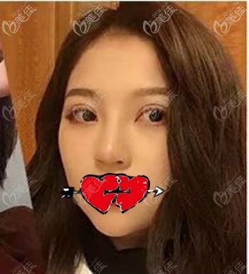 顯兇吊梢眼被說臉臭,讓武漢涵美割雙眼皮后秒變甜妹