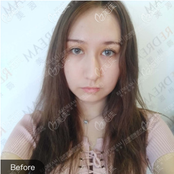 在<!--<i data=20240703-sp></i>-->做雙眼皮局部調(diào)整修復(fù)前 在<!--<i data=20240703-sp></i>-->做雙眼皮局部調(diào)整修復(fù)前