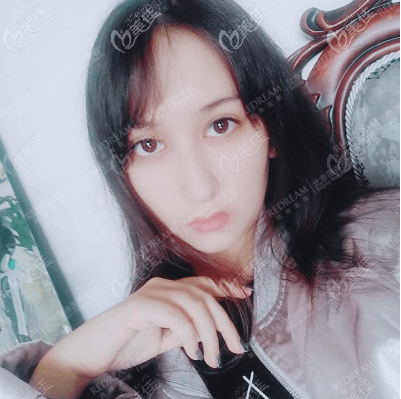 <!--<i data=20240703-sp></i>-->董香君雙眼皮修復(fù)案例 <!--<i data=20240703-sp></i>-->董香君雙眼皮修復(fù)案例