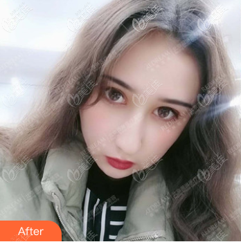 我是半年后找董香君做了雙眼皮失敗局部調整修復手術