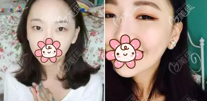 吊眼做雙眼皮的效果圖