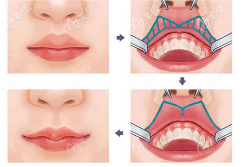 包頭葉子厚唇變薄手術(shù)原理和效果