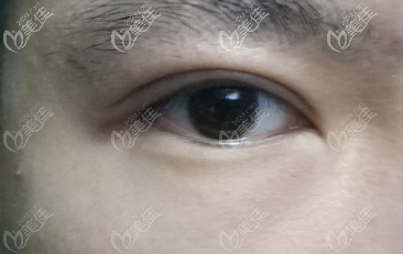 腫泡眼恢復(fù)到30天的樣子還是有肉條感