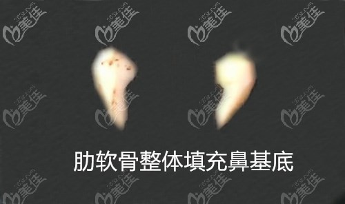 整塊肋軟骨填充鼻基底雕刻后的效果