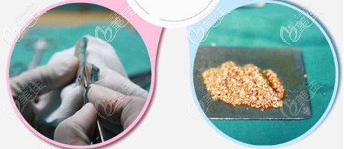 采用肋軟骨顆粒填充鼻基底