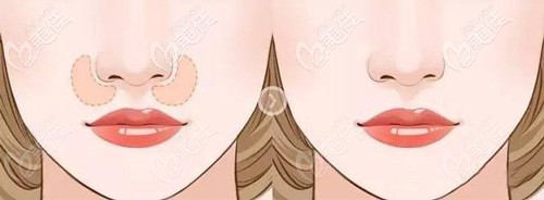 鼻基底凹陷呈現(xiàn)的面部效果