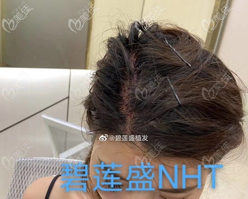 NHT不剃發(fā)植發(fā)技術(shù)術(shù)后即刻效果