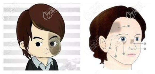 臉上有太田痣怎么改善