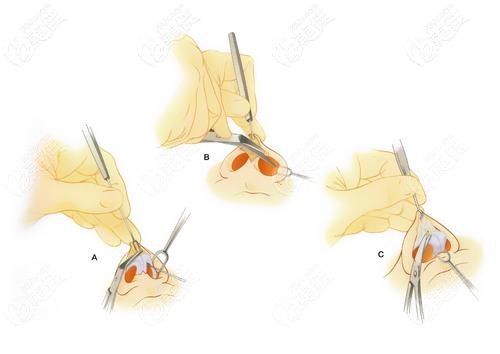 翟彥剛擅長(zhǎng)做鼻綜合手術(shù) 翟彥剛擅長(zhǎng)做鼻綜合手術(shù)