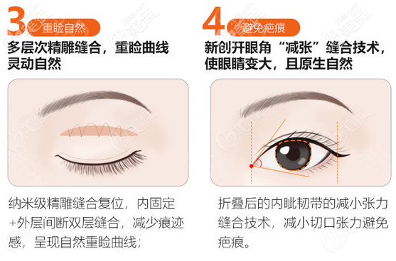 廣州美萊梁歡醫(yī)生雙眼皮優(yōu)勢明顯 廣州美萊梁歡醫(yī)生雙眼皮優(yōu)勢明顯