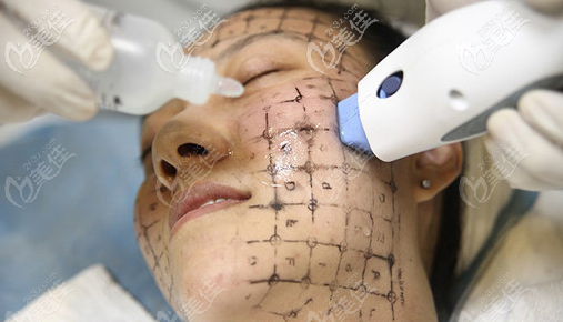 體驗(yàn)面部熱瑪吉 體驗(yàn)面部熱瑪吉