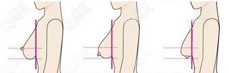 正常胸型和下垂的胸型對比