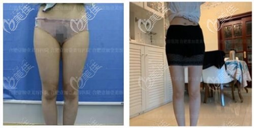 合肥壹加壹大腿吸脂案例