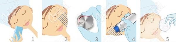 熱瑪吉的治療過(guò)程 熱瑪吉的治療過(guò)程