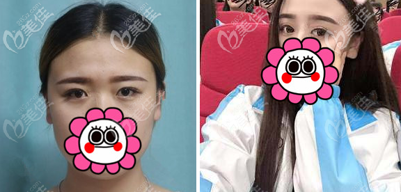 沈陽杏林張瑩瑩雙眼皮案例