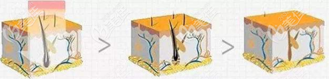 激光脫毛作用原理示意圖