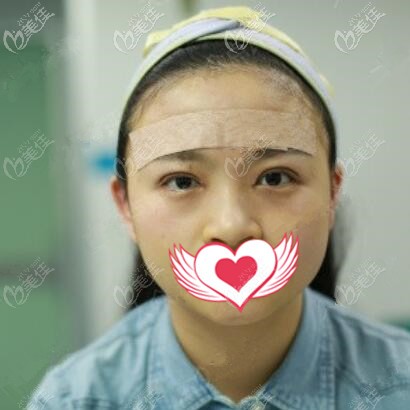 割雙眼皮開眼角術(shù)后即刻效果照