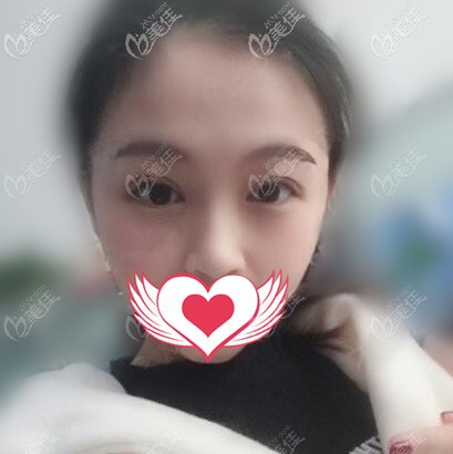 做雙眼皮眼綜合術(shù)后一周的效果照