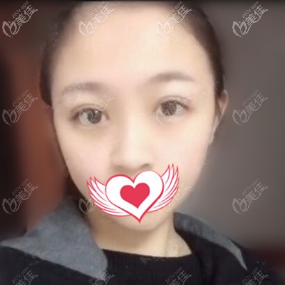 做眼綜合術(shù)后半個月的恢復(fù)效果照