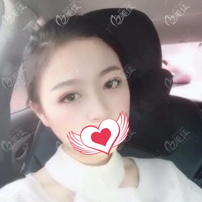 案例：長(zhǎng)沙卓而美真人割雙眼皮前后對(duì)比圖三十天恢復(fù)過(guò)程記錄，這變化太大了！